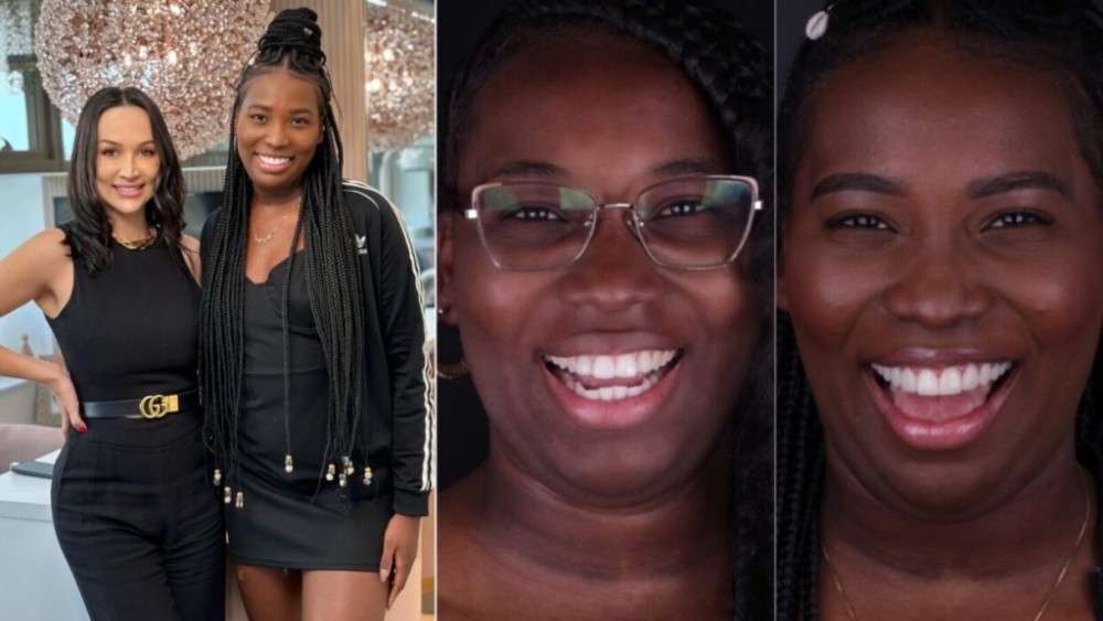 Transformação Estética: O Novo Sorriso de Leidy Elin, Ex-BBB 2024