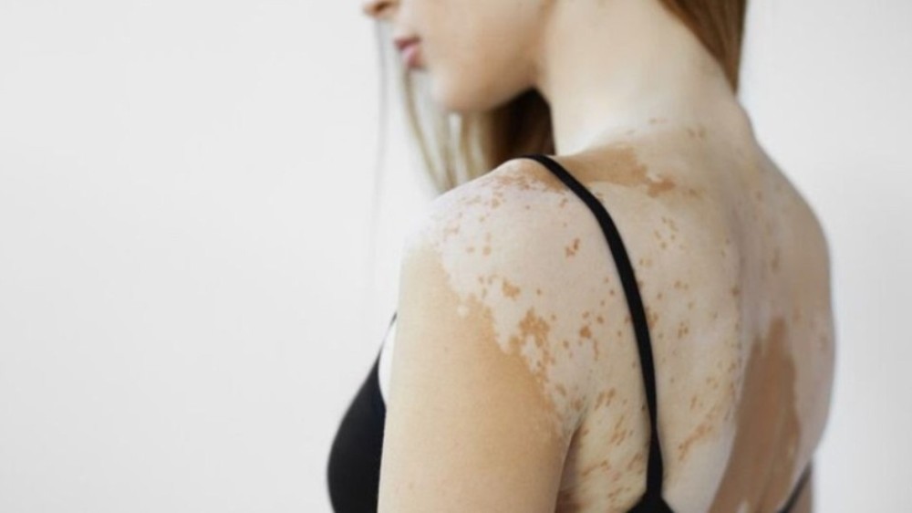 Vitiligo: confira dicas de cuidados especiais com a pele